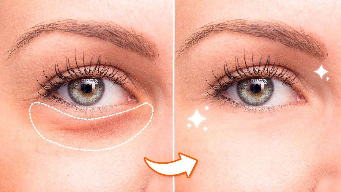 Can Glasses Make Your Eyes Baggy?